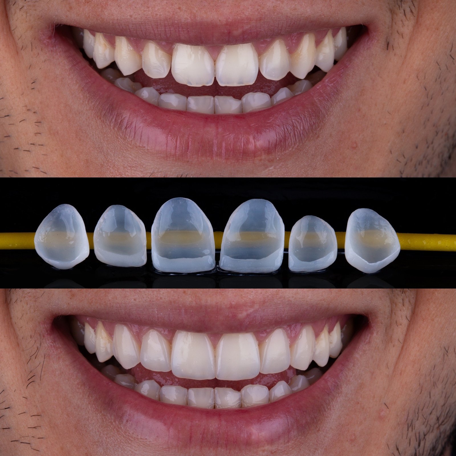 Cada vez mais populares, lentes de contato dental existem há quase um século