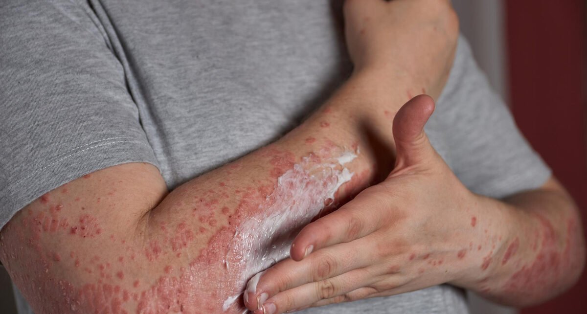 Justiça permite acesso ao omalizumabe para urticária crônica