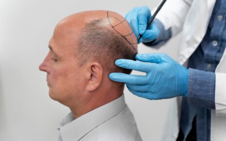 Turquia lidera procura internacional por transplante capilar