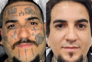 Remoção de tatuagem cresce e muda perfil de quem procura
